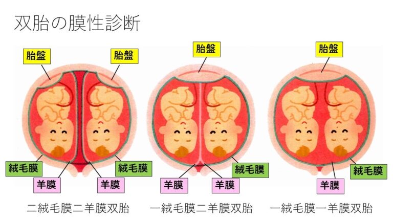 DD双胎・MD双胎・MM双胎について - 妊娠中のお悩み相談 - 平石こどもクリニック