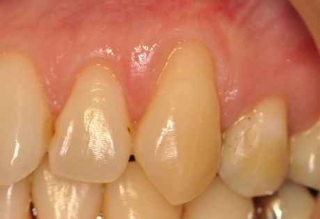 歯茎の退縮の画像